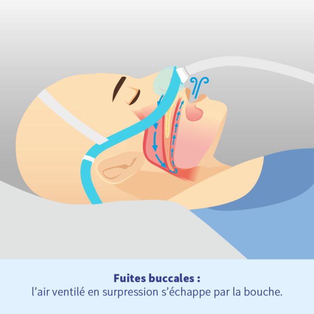 oxyhero CPAP pro contre les fuites buccales CPAP 02