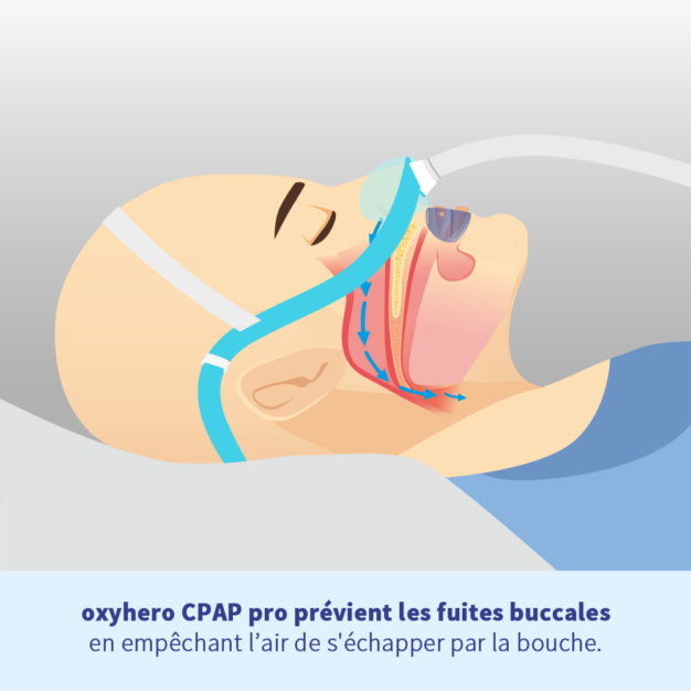 oxyhero CPAP pro contre les fuites buccales CPAP 2