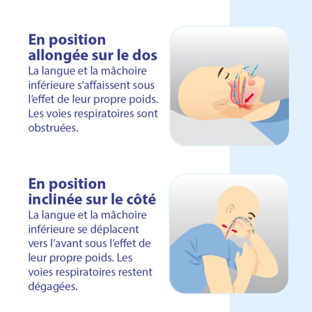 Explication ronflement sur le dos